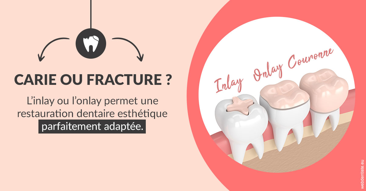 https://www.smileclinique83.fr/T2 2023 - Carie ou fracture 2