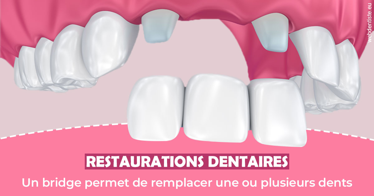 https://www.smileclinique83.fr/Bridge remplacer dents 2