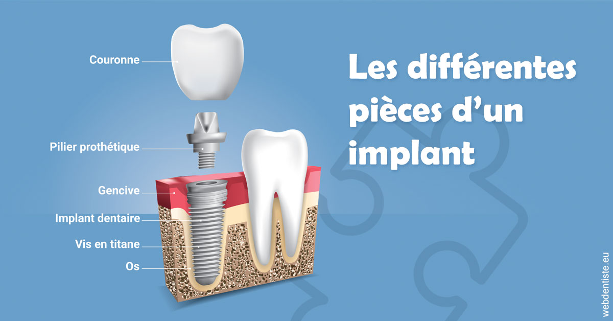 https://www.smileclinique83.fr/Les différentes pièces d’un implant 1